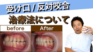 【手術なし】【抜歯なし】【短期間で完治】受け口の治療法について